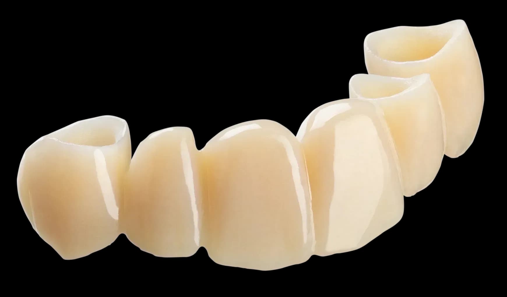 3D-gedruckte Provisorien – Schnelle und exakte Lösungen für Zahntechniker